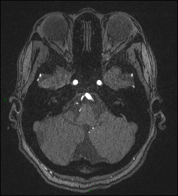 Cerebral fat embolism (Radiopaedia 35022-36525 Axial TOF 39).jpg