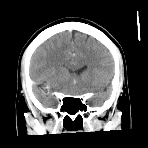 Cerebral hemorrhage secondary to arteriovenous malformation (Radiopaedia 33497-34561 C 24).png