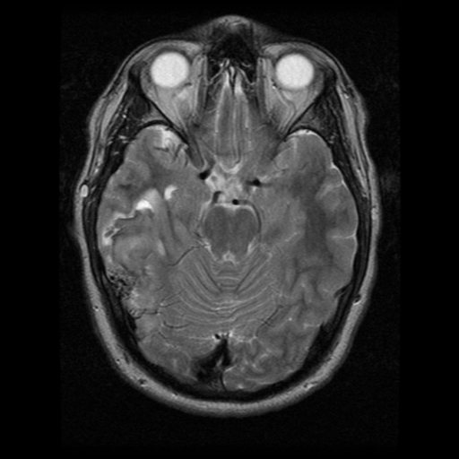 File:Cerebral hemorrhage secondary to arteriovenous malformation (Radiopaedia 33497-34572 Axial T2 9).png