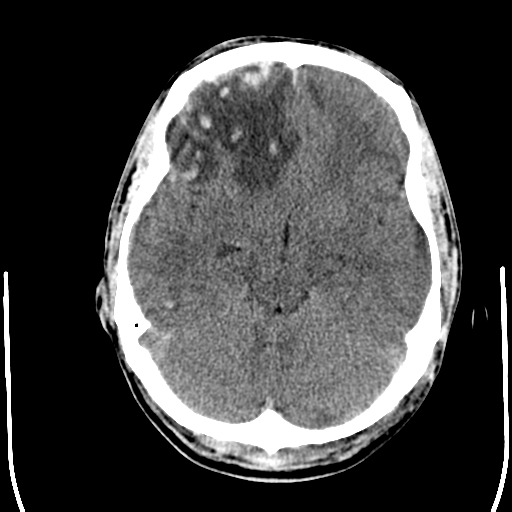 File:Cerebral hemorrhagic contusions- temporal evolution (Radiopaedia 40224-42754 Axial non-contrast 10).png