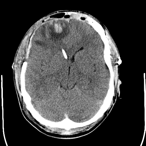 File:Cerebral hemorrhagic contusions- temporal evolution (Radiopaedia 40224-42755 AXIAL THICK 13).png