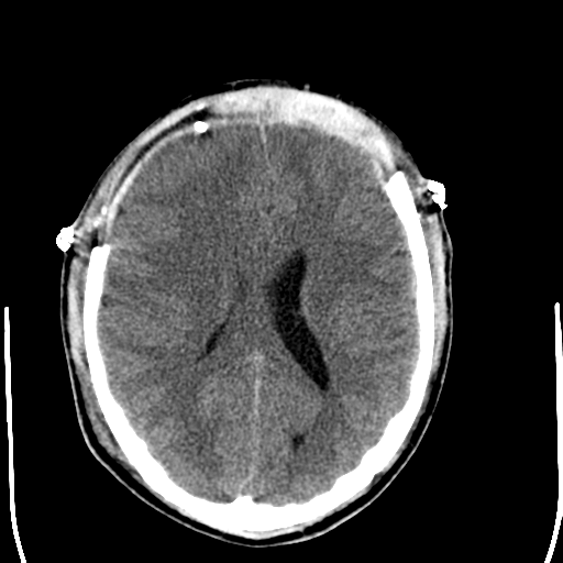 File:Cerebral hemorrhagic contusions- temporal evolution (Radiopaedia 40224-42755 AXIAL THICK 19).png