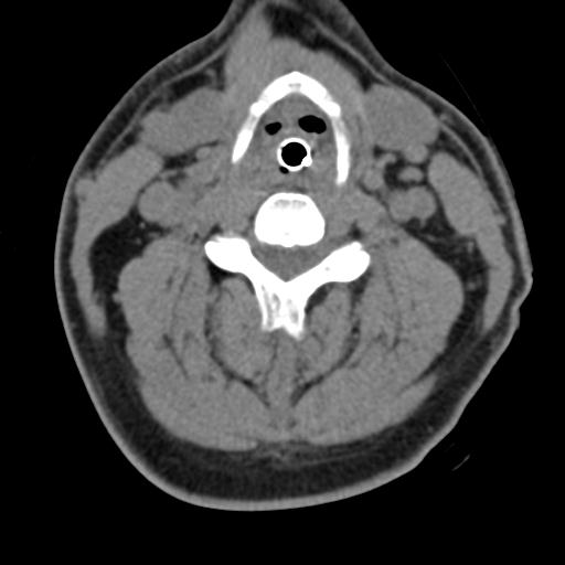 Cerebral hemorrhagic contusions and cervical spine fractures (Radiopaedia 32865-33841 F 27).jpg