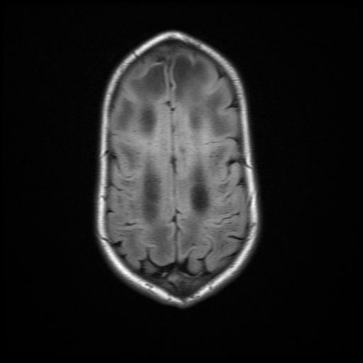 File:Cerebral manifestations of mucopolysaccharidosis type I (Radiopaedia 59171-66487 C 17).jpg