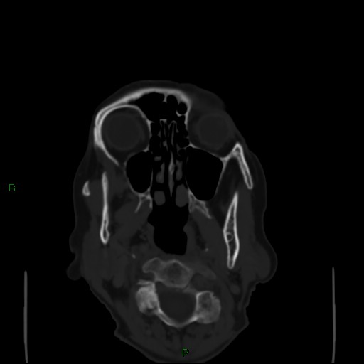 File:Cerebral metastases - breast primary (Radiopaedia 77653-89857 Axial bone window 1).jpg