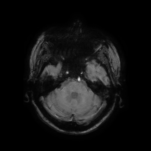 File:Cerebral metastases - melanoma (Radiopaedia 80972-94522 Axial SWI 27).jpg