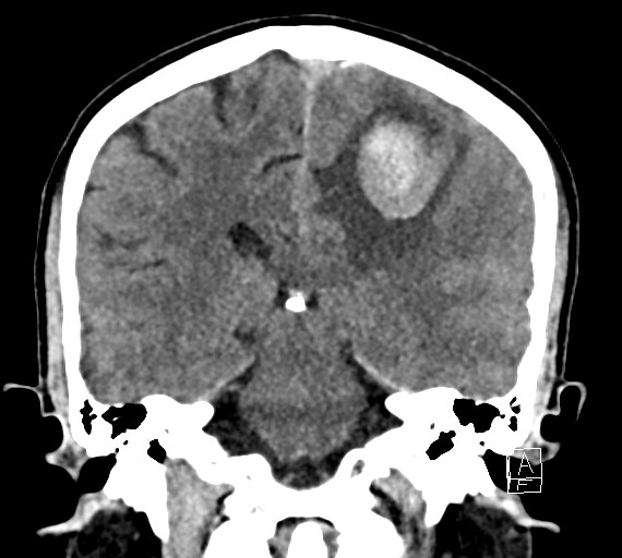 Cerebral metastases - testicular choriocarcinoma (Radiopaedia 84486-99855 Coronal C+ delayed 38).jpg