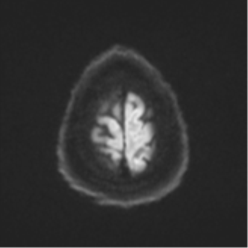 Cerebral metastases mimicking multifocal glioblastoma (Radiopaedia 50843-56353 Axial DWI 53).png