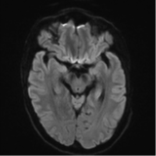 File:Cerebral metastasis - melanoma (Radiopaedia 54718-60954 Axial DWI 43).png