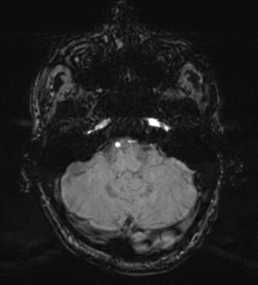 Cerebral metastasis - melanoma (Radiopaedia 54718-60954 Axial SWI 12).png