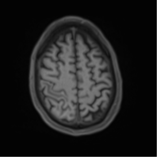Cerebral metastasis - melanoma (Radiopaedia 54718-60954 Axial T1 43).png