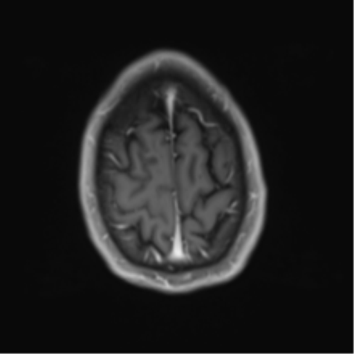 Cerebral metastasis - melanoma (Radiopaedia 54718-60954 Axial T1 C+ fat sat 46).png