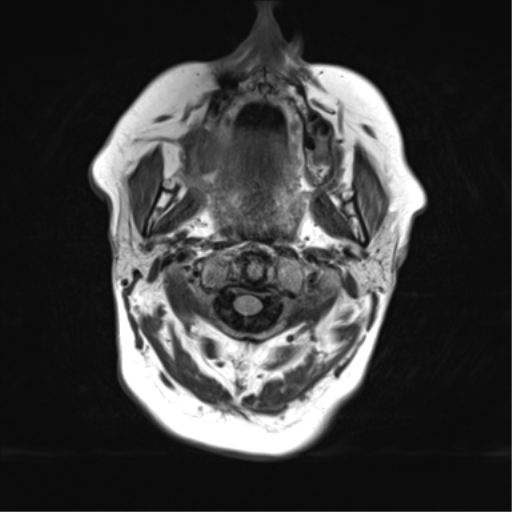 File:Cerebral metastasis mimicking glioblastoma (Radiopaedia 69155-78937 Axial FLAIR 1).png