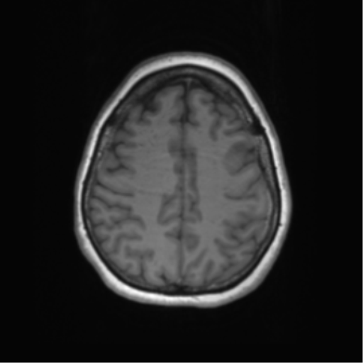 Cerebral metastasis mimicking glioblastoma (Radiopaedia 69155-78937 Axial T1 51).png