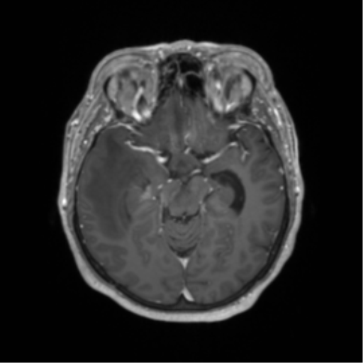 Cerebral metastasis to basal ganglia (Radiopaedia 81568-95413 Axial T1 C+ 28).png