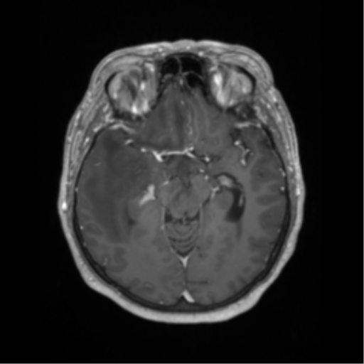 Cerebral metastasis to basal ganglia (Radiopaedia 81568-95413 Axial T1 C+ 29).png