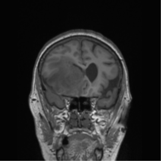 Cerebral metastasis to basal ganglia (Radiopaedia 81568-95413 Coronal T1 43).png