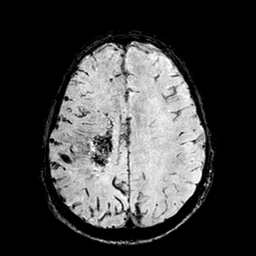 Cerebral parenchymal arteriovenous malformation (Radiopaedia 27280-27456 Axial SWI 81).jpg