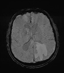 File:Cerebral toxoplasmosis (Radiopaedia 43956-47461 Axial SWI 22).jpg
