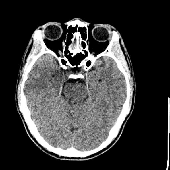 Cerebral toxoplasmosis (Radiopaedia 53993-60131 Axial non-contrast 29).jpg