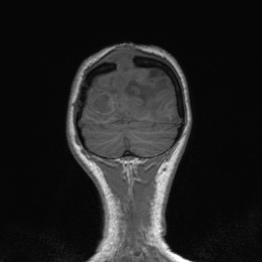 Cerebral tuberculosis with dural sinus invasion (Radiopaedia 60353-68090 Coronal T1 159).jpg