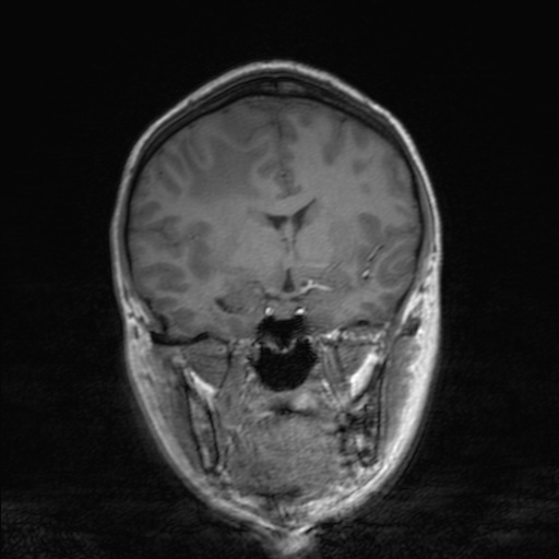 Cerebral tuberculosis with dural sinus invasion (Radiopaedia 60353-68090 Coronal T1 84).jpg