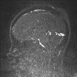 Cerebral tuberculosis with dural sinus invasion (Radiopaedia 60353-68090 Sagittal MRV 70).jpg