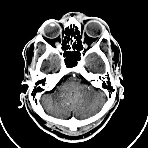 File:Cerebral venous angioma (Radiopaedia 69959-79977 B 7).jpg