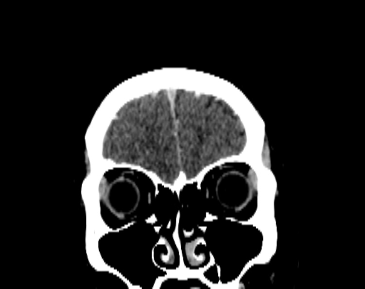 Cerebral venous hemorrhagic infarct from venous sinus thrombosis (Radiopaedia 55433-61883 Coronal C+ delayed 16).jpg