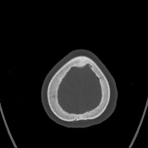 Cerebral venous infarction with hemorrhage (Radiopaedia 65343-74381 Axial bone window 180).jpg