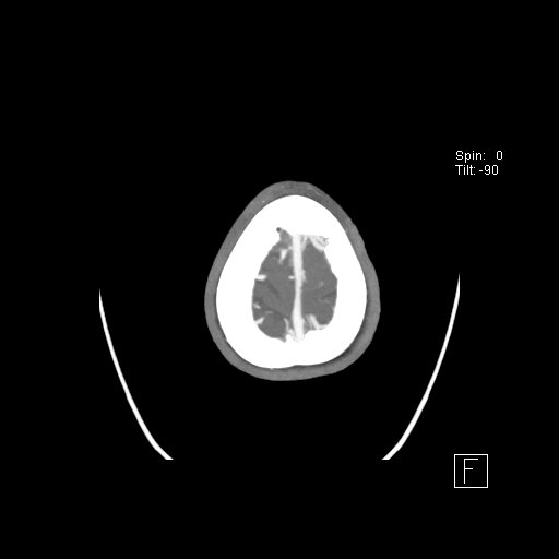 Cerebral venous infarction with hemorrhage (Radiopaedia 65343-74396 A 131).jpg