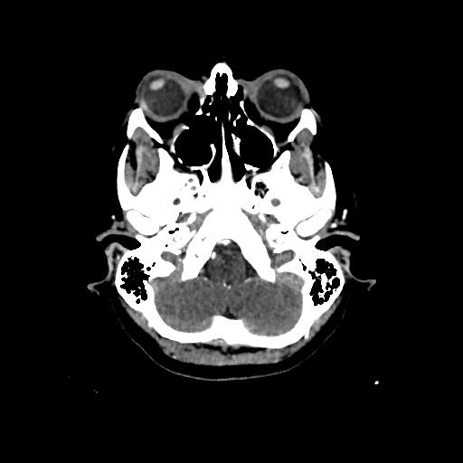 File:Cerebral venous throbmosis - hemorrhagic venous infarction (Radiopaedia 87318-103613 Axial CT venogram 1).jpg