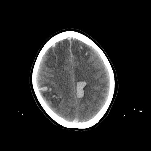 Cerebral venous throbmosis - hemorrhagic venous infarction (Radiopaedia 87318-103613 Axial non-contrast 124).jpg