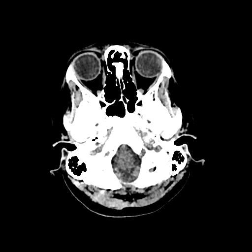 Cerebral venous throbmosis - hemorrhagic venous infarction (Radiopaedia 87318-103613 Axial non-contrast 22).jpg