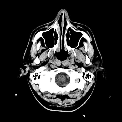 File:Cerebral venous thrombosis (CVT) (Radiopaedia 77524-89685 Axial non-contrast 3).jpg