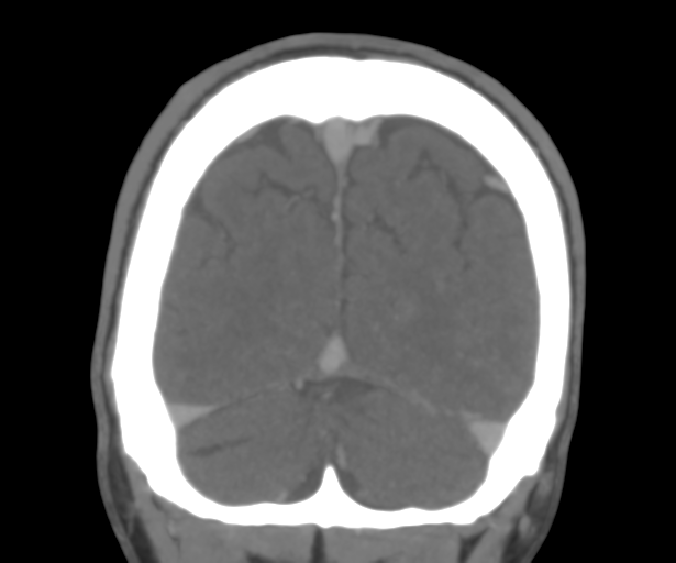 Cerebral venous thrombosis (Radiopaedia 38392-40467 Coronal CTA-Venogram 53).png