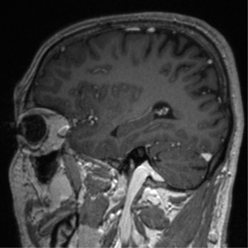 Cerebral venous thrombosis (Radiopaedia 38392-40469 Sagittal T1 C+ 62).png