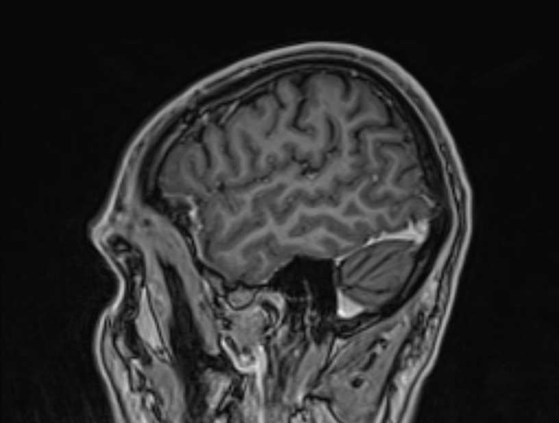 Cerebral venous thrombosis (Radiopaedia 71207-81504 Sagittal T1 C+ 8).jpg