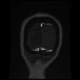 Cerebral venous thrombosis - ulcerative colitis (Radiopaedia 66049-75219 Coronal MRV 14).jpg