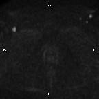 Cervical adenocarcinoma (Radiopaedia 65011-73985 Axial DWI 8).jpg