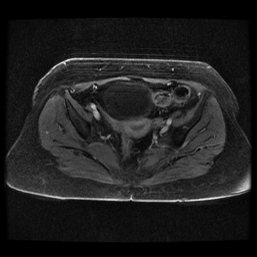 Cervical carcinoma (Radiopaedia 70924-81132 Axial T1 C+ fat sat 147).jpg