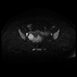 Cervical carcinoma (Radiopaedia 88010-104555 Axial DWI 52).jpg