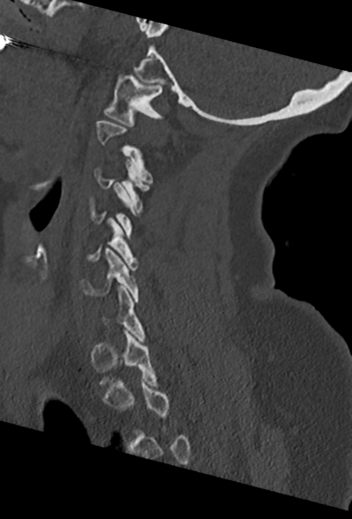 Cervical spine ACDF loosening (Radiopaedia 48998-54070 Sagittal bone window 59).png