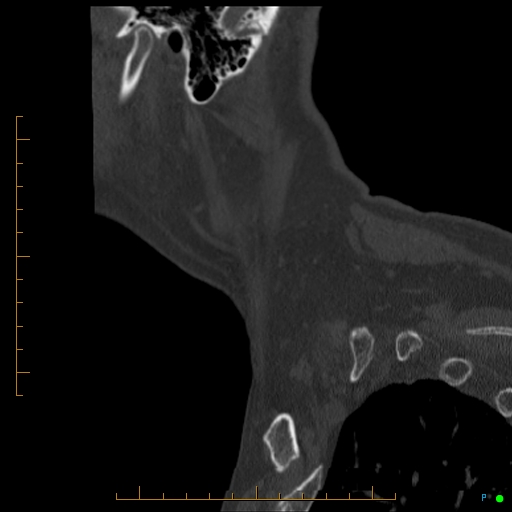 File:Cervical spine fracture - ankylosing spondylitis (Radiopaedia 76835-88706 Sagittal bone window 8).jpg