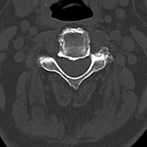 Cervical spine fracture - chalk stick (Radiopaedia 39116-41323 Axial bone window 35).png