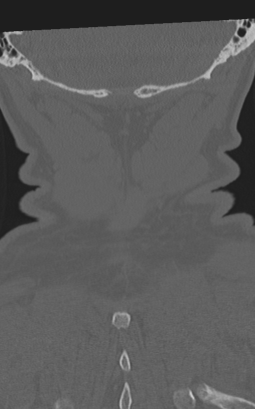 Cervical spine fractures with vertebral artery dissection (Radiopaedia 53296-59268 Coronal bone window 64).png