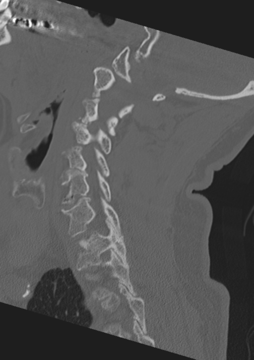 Cervical spine fractures with vertebral artery dissection (Radiopaedia 53296-59268 Sagittal bone window 43).png