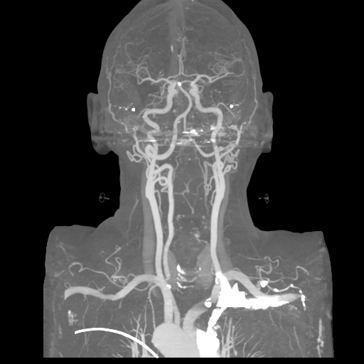 File:Cervical spine fractures with vertebral artery dissection (Radiopaedia 53296-59269 3D MIP 9).png