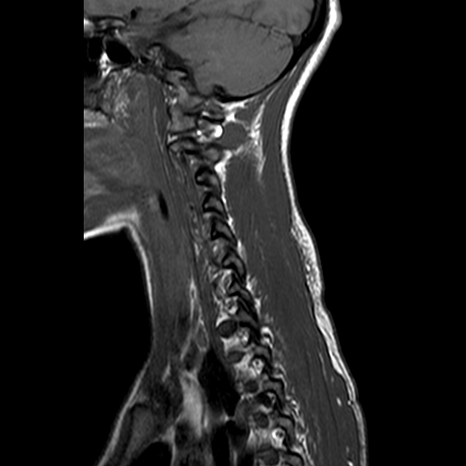 File:Cervical spine posterior ligamentous complex rupture (Radiopaedia 63486-72103 Sagittal T1 11).jpg