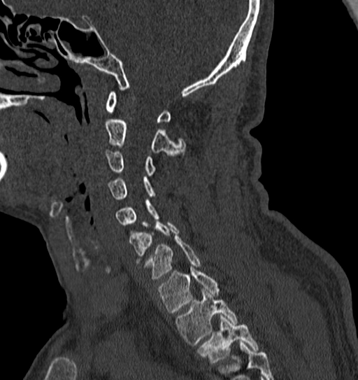 File:Cervical spine trauma with tear drop fracture and perched facet joint (Radiopaedia 53989-60127 Sagittal bone window 105).jpg